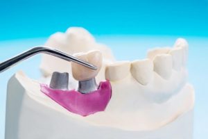implantar diente